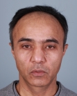 Before Hair Transplant &nbsp;Front